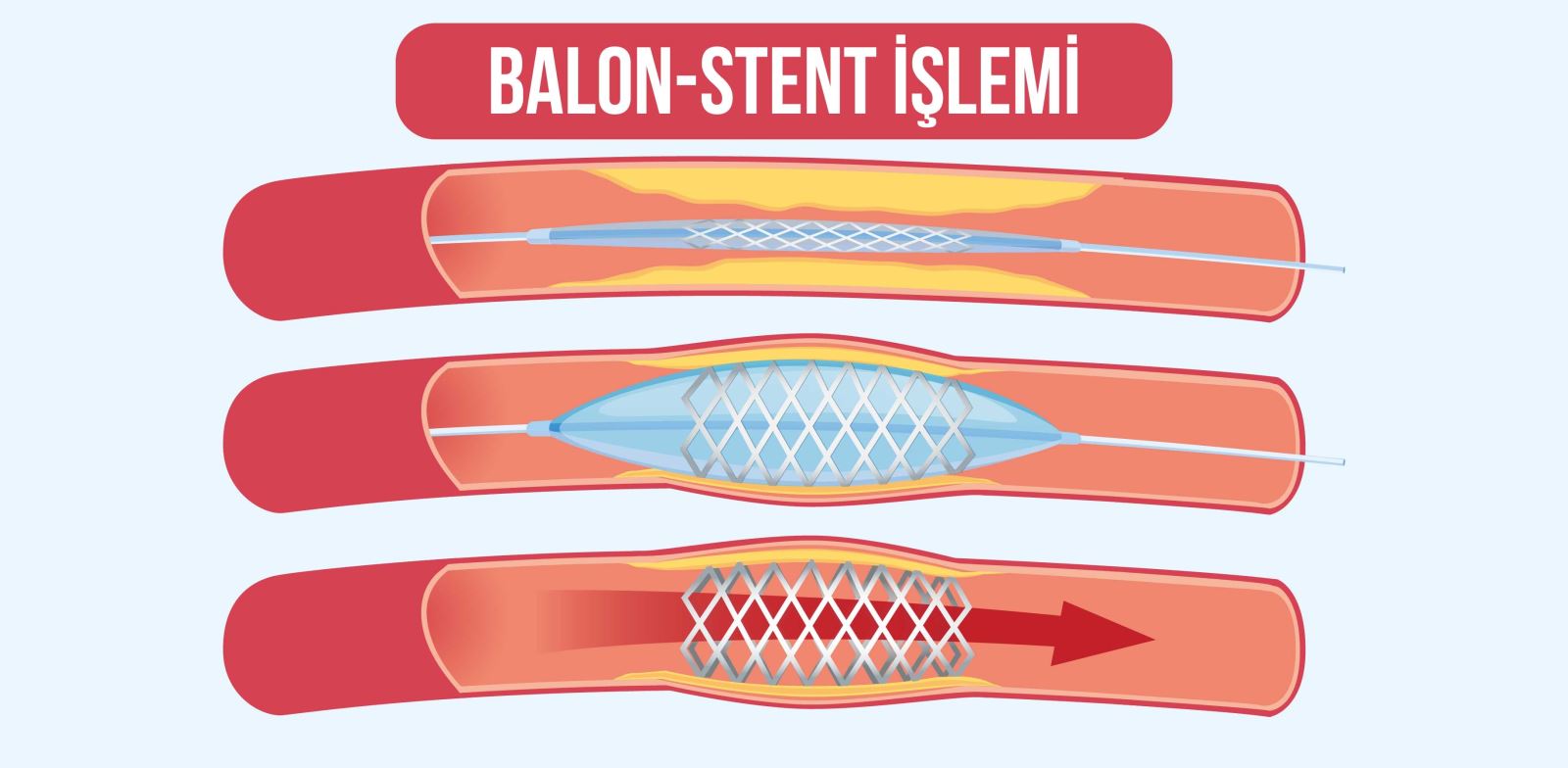 Balon-stent işlemi