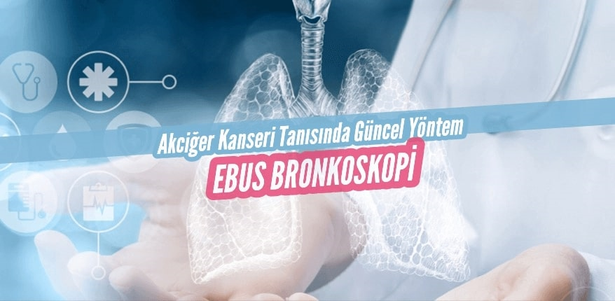 Akciğer Kanseri Tanısında Güncel Yöntem Ebus Bronkoskopi 