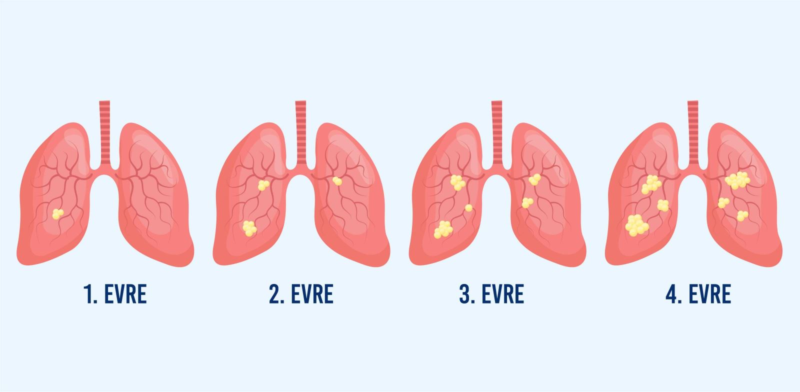 Akciğer kanserinde 4 evre vardır.