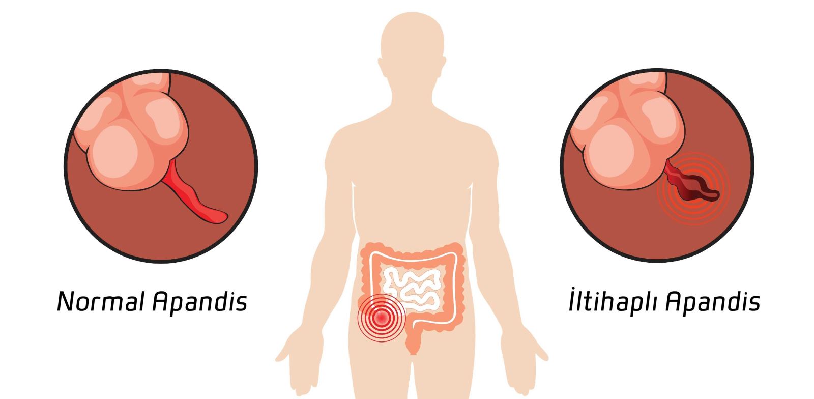 Apandisit, apendiks adı verilen bir organın iltihaplanmasıdır.
