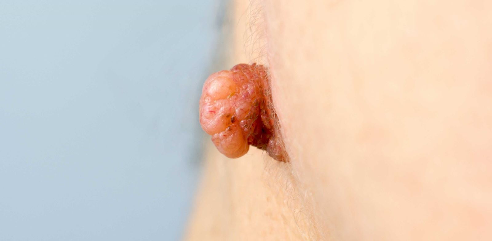 En sık görülen hpv belirtisi genital siğillerdir.
