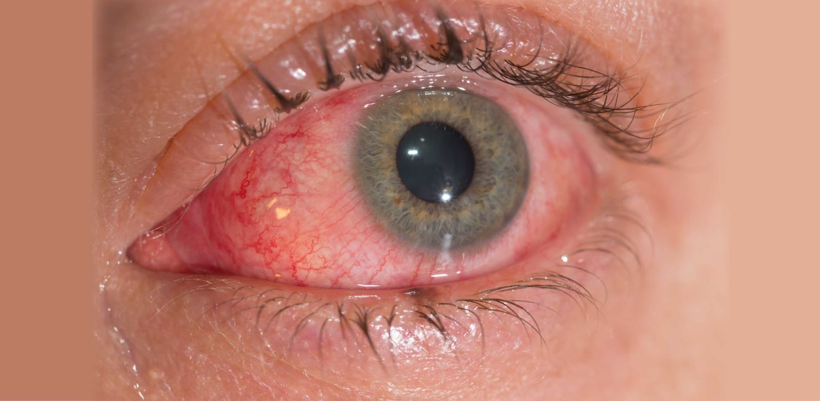 Kırmızı göz hastalığı kaç günde geçer?