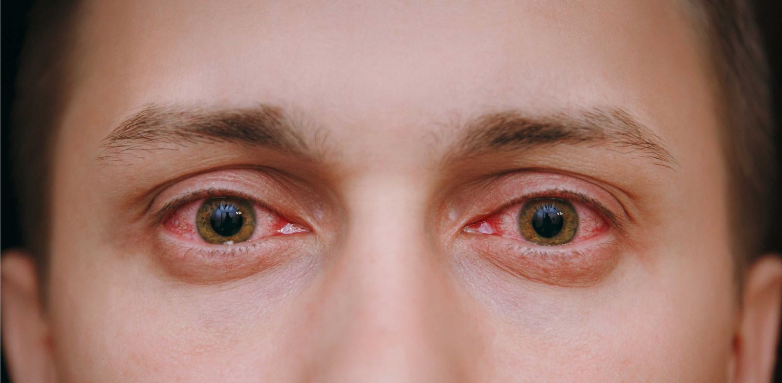 Kırmızı göz hastalığı salgını