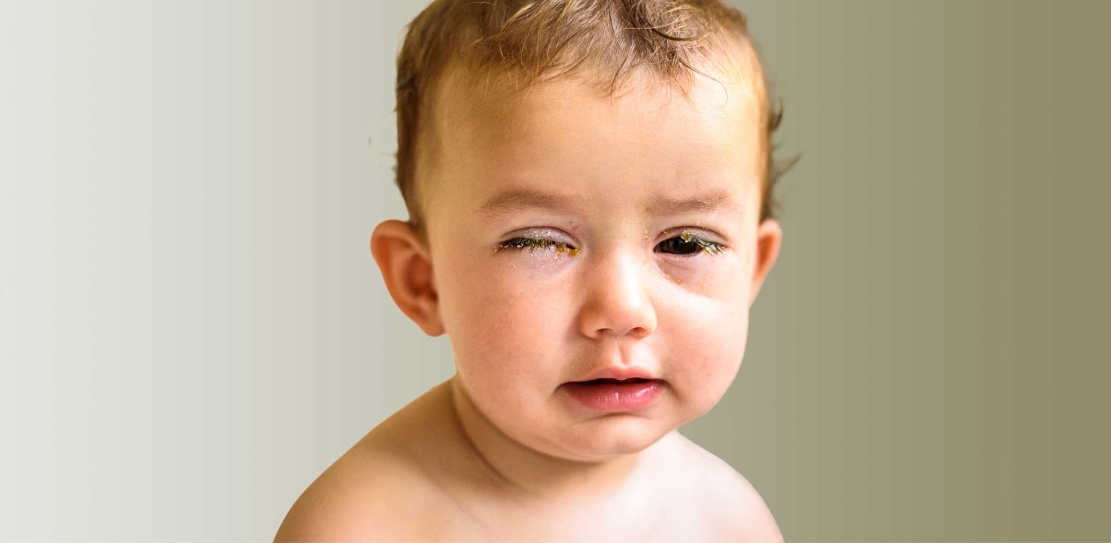 Bebeklerde kırmızı göz hastalığı