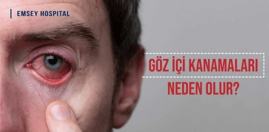 Göz İçi Kanamaları Neden Olur?