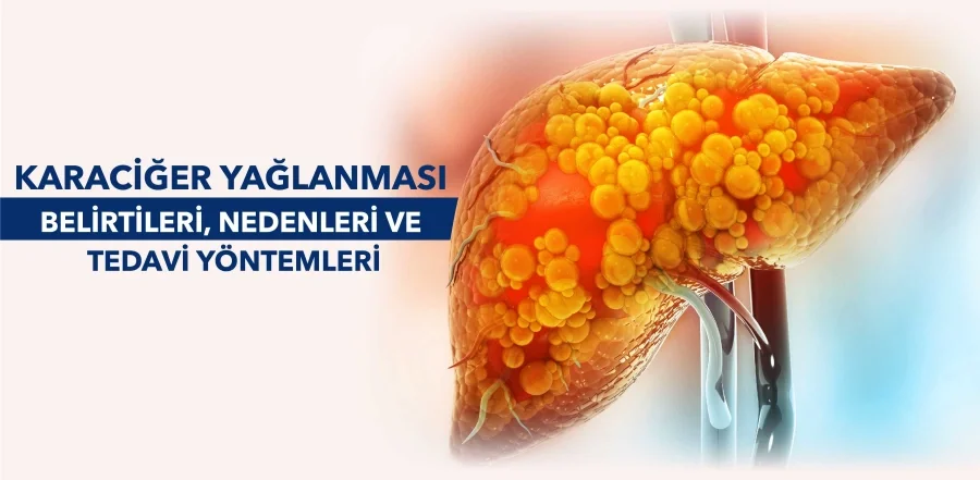 Karaciğer Yağlanması: Belirtileri, Nedenleri ve Tedavi Yöntemleri