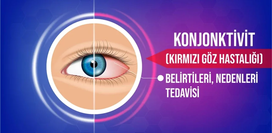 Konjonktivit (Kırmızı Göz Hastalığı) Belirtileri, Nedenleri ve Tedavisi