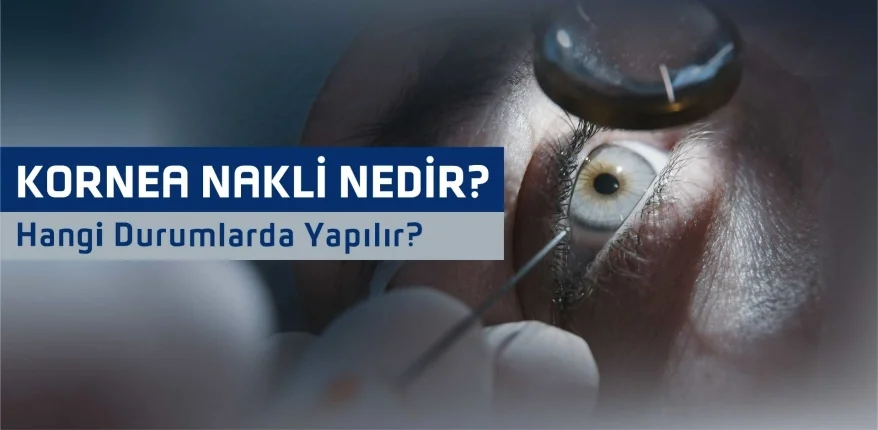 Kornea Nakli Nedir ve Hangi Durumlarda Yapılır?