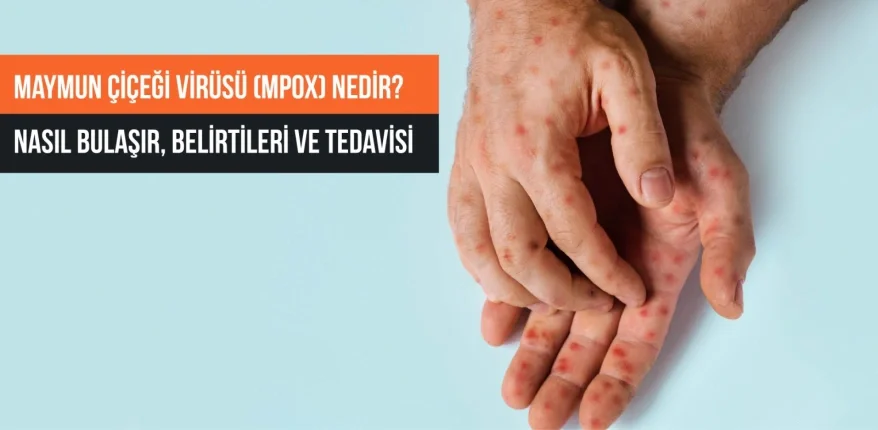 Maymun Çiçeği Virüsü (Mpox) Nedir? Nasıl Bulaşır, Belirtileri ve Tedavisi