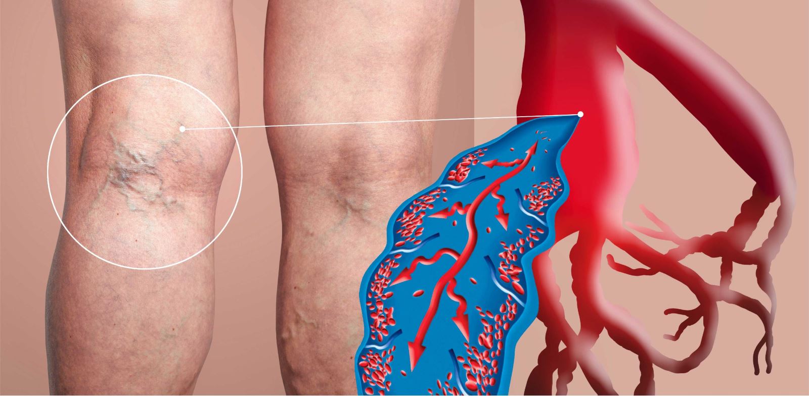 Bacaklarda mavi veya mor damarlar varis belirtisidir.